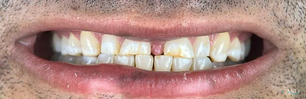 Smile-Makeover-Fall, vor der Behandlung
