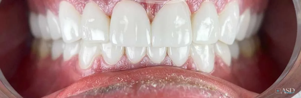 Smile-Makeover-Fall, nach der Behandlung