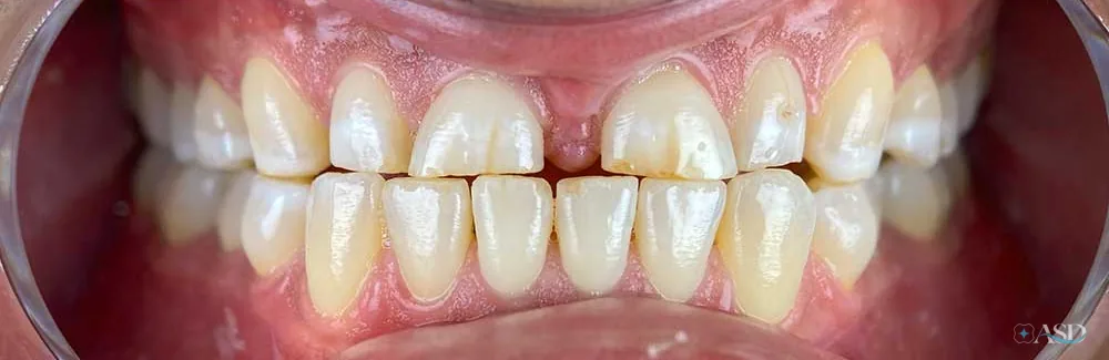 Smile-Makeover-Fall, vor der Behandlung