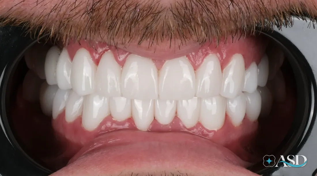 Veneers case 1, after treatment