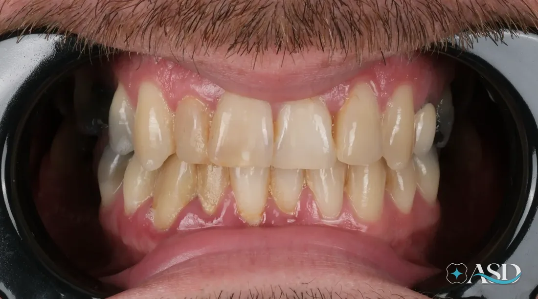 Veneers case 1, before treatment