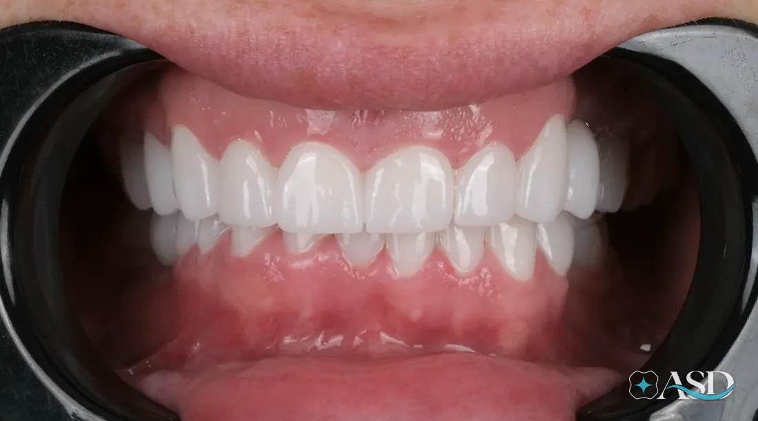 Veneers case 2, after treatment
