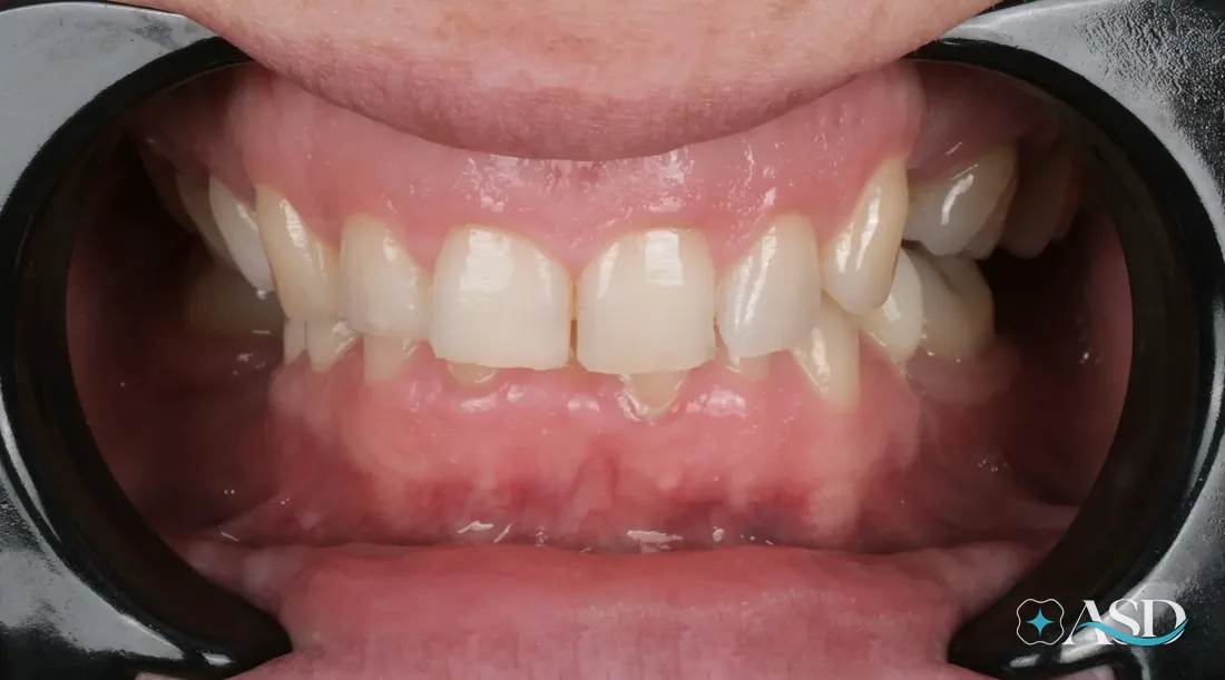 Veneers case 2, before treatment