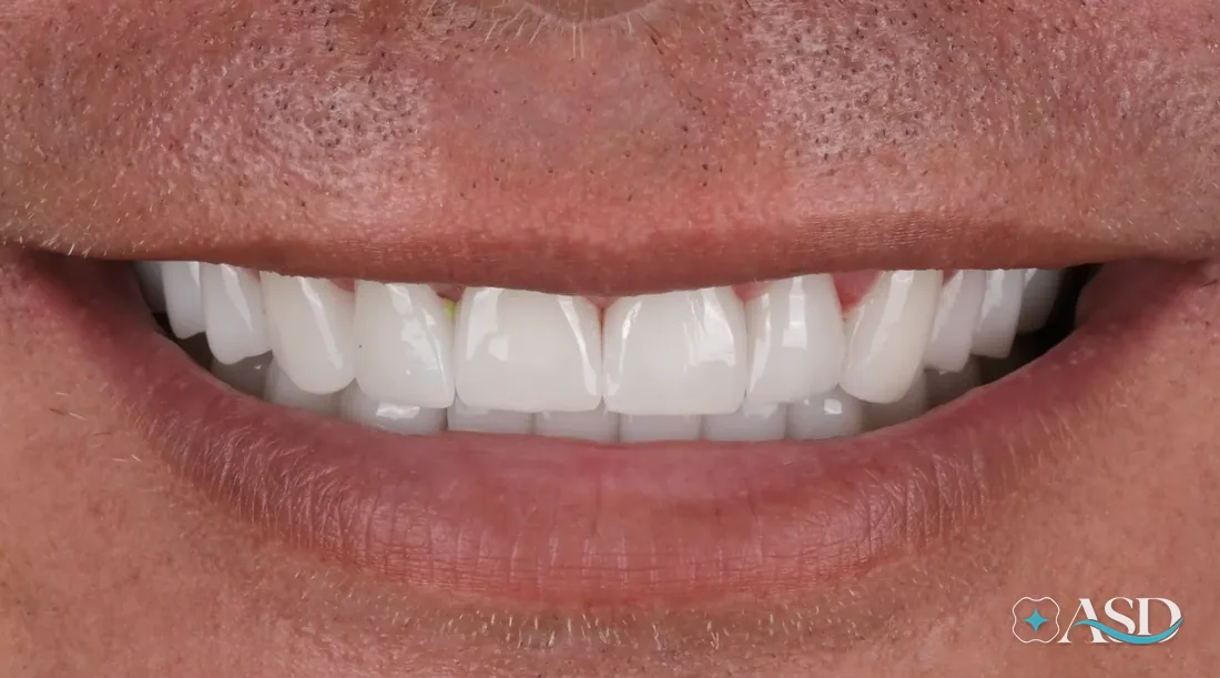 Veneers case 3, after treatment