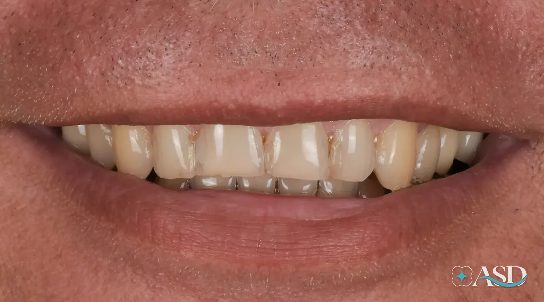 Veneers case 3, before treatment